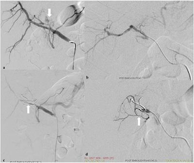 Contemporary Role of Embolization of Solid Organ and Pelvic Injuries in Polytrauma Patients